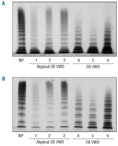 Reduced Survival Of Type 2b Von Willebrand Factor Irrespective Of Large Multimer Representation