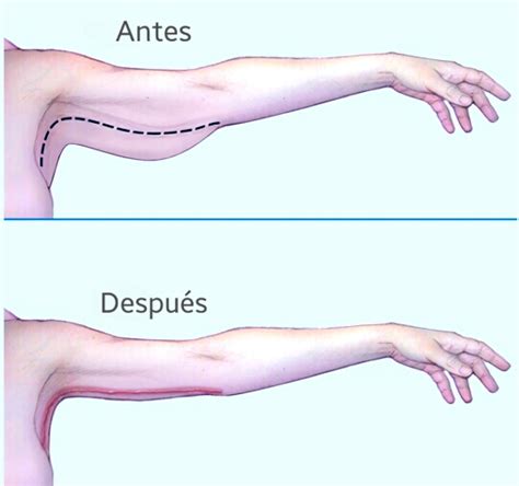 Braquioplastia Euroderma