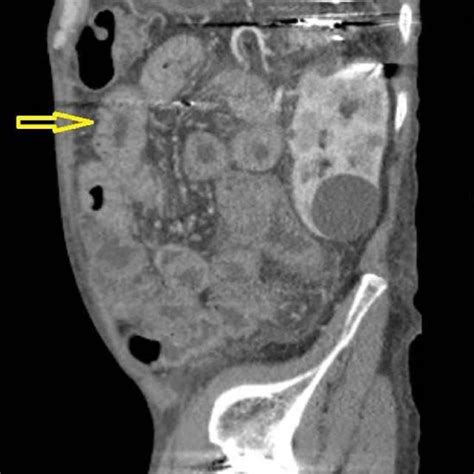 Sagittal View Of Computed Tomography Enterography Showing Diffuse