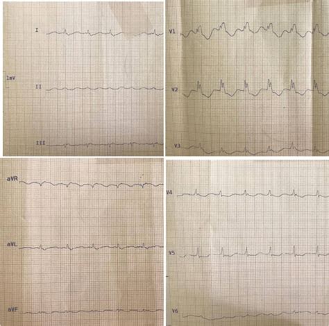 Initial Electrocardiogram Ecg Showing Sinus Tachycardia At The Rate