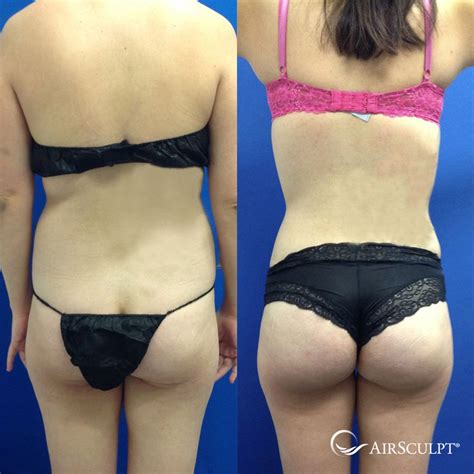 Pin On Airsculpt® Before And After Elite Body Sculpture