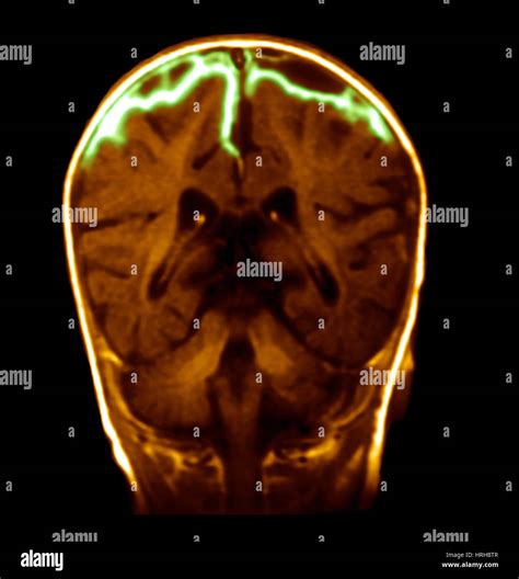 Cerebral Meningitis Hi Res Stock Photography And Images Alamy