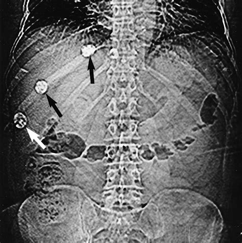 Hydatid Disease Radiologic And Pathologic Features And Complications