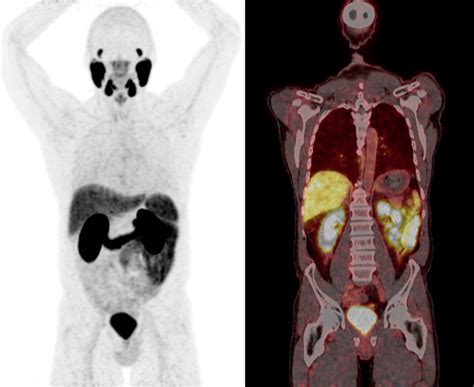 Le Psma Pet Ct En Cas De Cancer De La Prostate