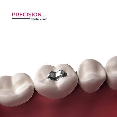 🤔 Чому може випасти пломба? Найпоширеніші причини