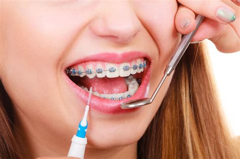 Importance of Regular Braces Appointment | McDonald Orthodontic