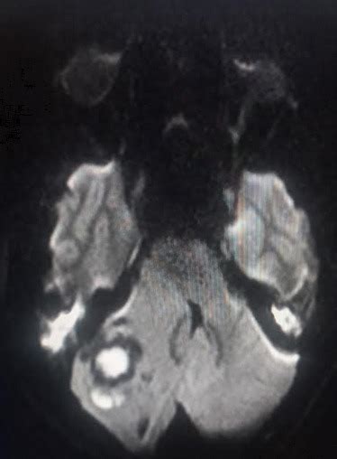 Brain Abscess Statpearls Ncbi Bookshelf