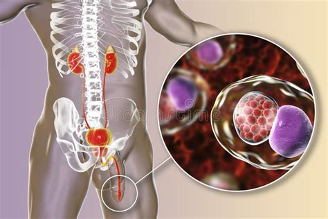 Chlamydiosis Infection In Man Stock Illustration Illustration Of