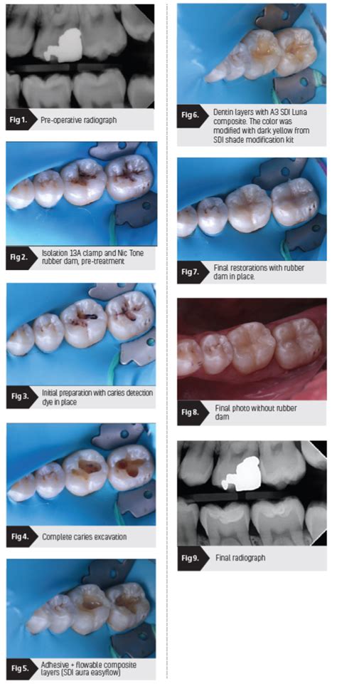 Restoring Class 1 Decay A Case Study Oral Health Group