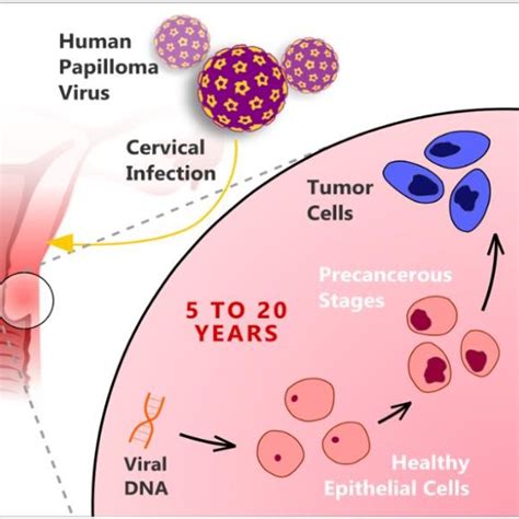 A normal cervix undergoes precancerous stage and finally turns to ...