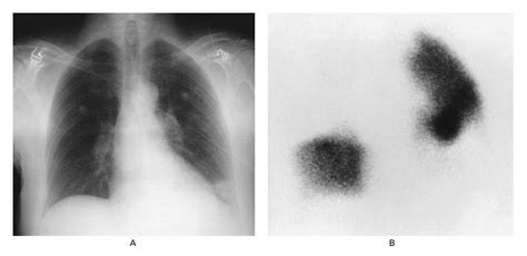 Pulmonary Embolism — Nejm