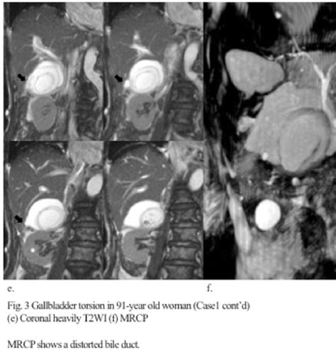 Figure 1 From Mr Findings Of Gallbladder Torsion And Acute Gangrenous Cholecystitis