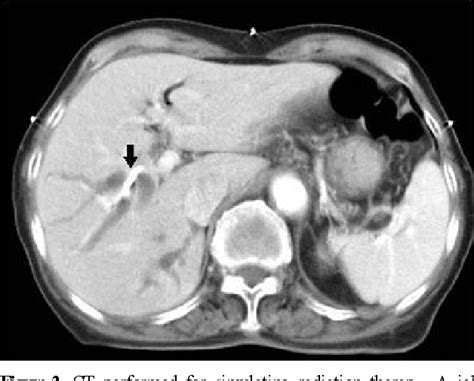 PDF A Case Of Emphysematous Hepatitis With Spontaneous