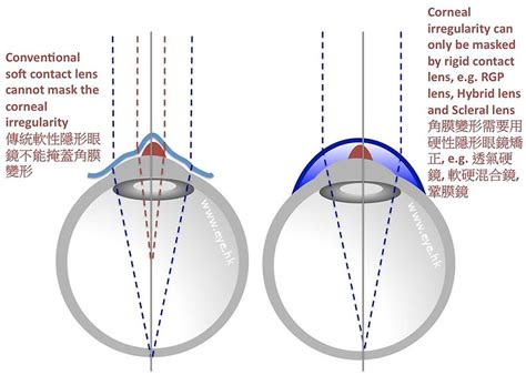 Specialty Contact Lenses Hong Kong Eye Hk Rgp Keratoconus Post