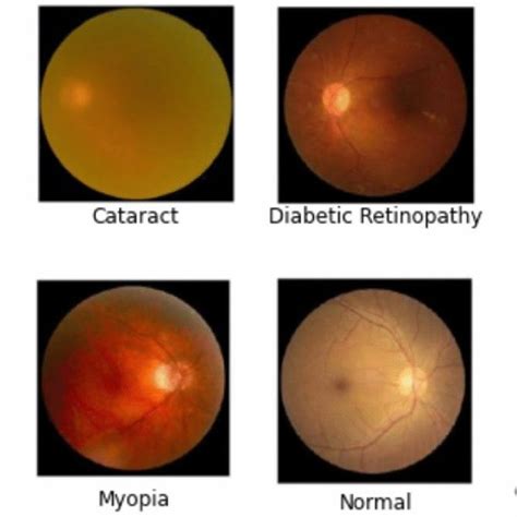 Examples Of Digital Fundus Images Containing Ocular Diseases Obtained