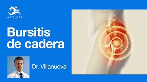 Bursitis De La Cadera Y Tendinitis Del Psoas Causas Y Tratamiento