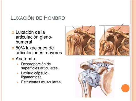 Luxación De Hombro