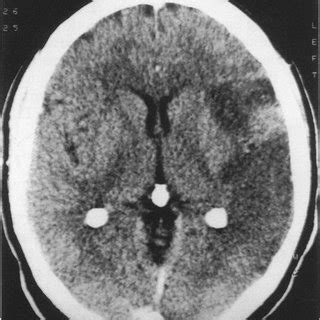 Head CT scan post-contrast | Download Scientific Diagram