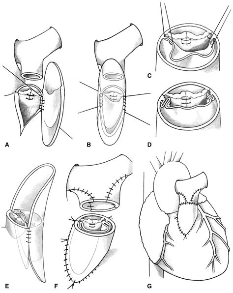 Transannular The American Association For Thoracic Surgery AATS