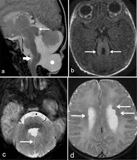 Brain Mri At Age 5 Days A Sagittal T2 Weighted Image Demonstrates A