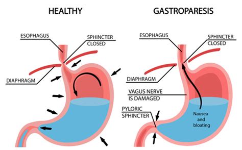 Ozempic & Stomach Problems | Gastroparesis