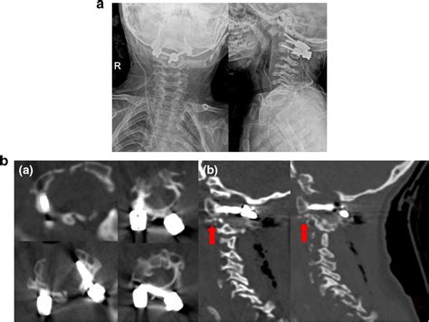 A Postoperative Cervical X Ray B A Postoperative Cervical CT Scan