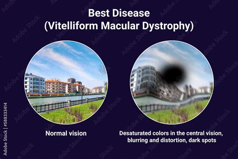 The Difference Between The Vision Of A Normal Eye And An Eye Affected