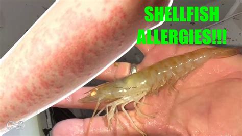 Having An Allergic Reaction While Cooking Shellfish Youtube