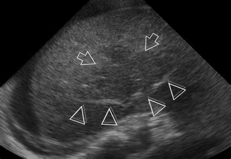 Budd Chiari Syndrome Ultrasound