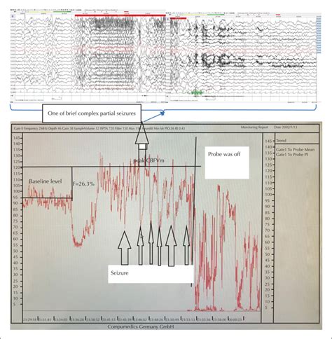 JLE Epileptic Disorders Ictal Cerebral Haemodynamic Characteristics