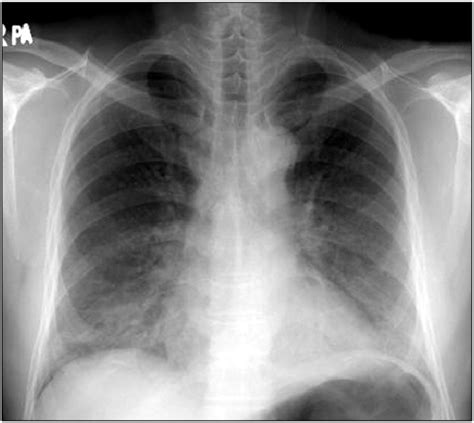 Chest Pa Shows Diffuse Bilateral Haziness In Both Lower Lobes With