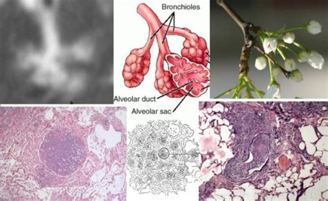 Bronchial Obstruction In Developing Post Primary Tb The Tree In Bud Download Scientific