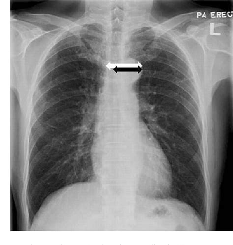 Figure 1 From Title Diagnostic Accuracy Of Mediastinal Width