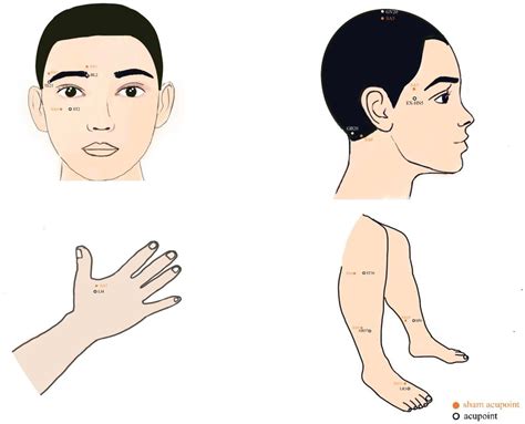 Electroacupuncture for mild-to-moderate dry eye: study protocol for a multicentre, randomised ...