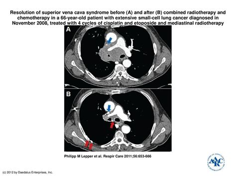 Resolution Of Superior Vena Cava Syndrome Before A And After B