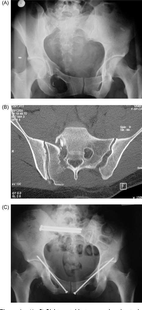 Figure From Closed Reduction And Iliosacral Percutaneous Fixation Of