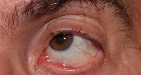 Dry Eye, Autoimmune (Keratoconjunctivitis Sicca) – Gluten Free Works ...