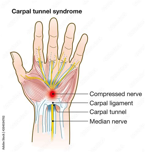 Carpal Tunnel Syndrome Diagram