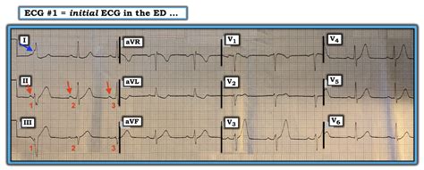 Dr. Smith's ECG Blog: Prehospital ECG of a 50-something male with ...