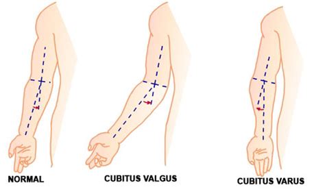 Valgus Vs Varus Of Ankle