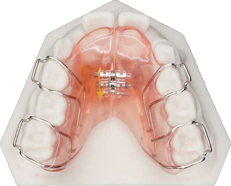 Upper Expander Protec Dental