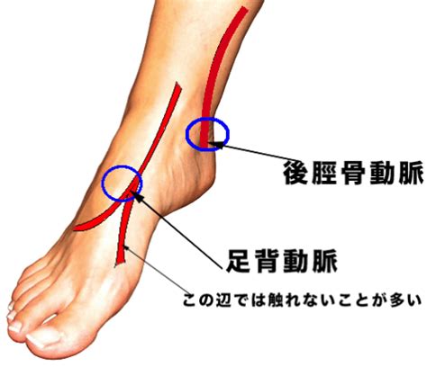 打撲だと思って放置していたら、翌朝歩けなくなっていて内出血していた！