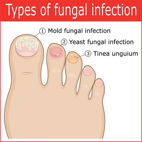 Toe Pain And Discolored Toenails