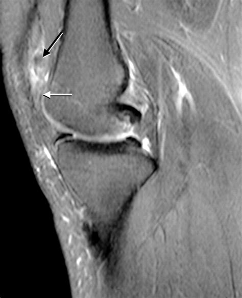 Localized Pigmented Villonodular Synovitis Arthroscopic Treatment Of A