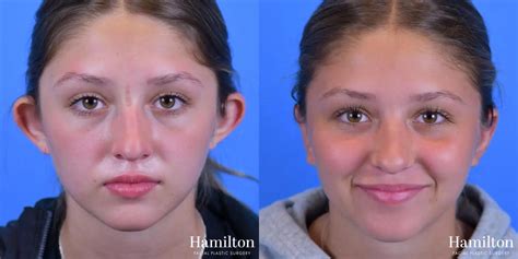 Otoplasty Before And After Gallery