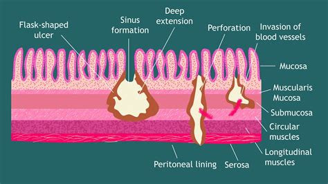 Pathogenesis Of Entamoeba Histolytica Notes Parasitology Basic Science Series Youtube