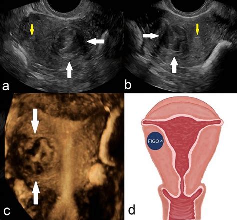 Figo 4—intramural Leiomyoma With No Endometrial Or Subserosal Contact