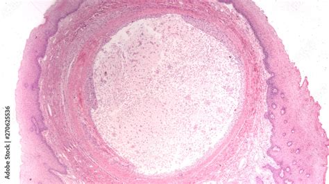 Microscopic Image Of A Mucocele Mucus Cyst A Fluid Filled Swelling