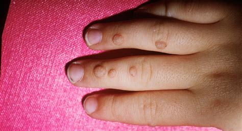 Warts In Babies And Children Babycenter