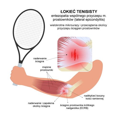 Łokieć tenisisty przyczyny objawy i leczenie zabiegi osocze PRP